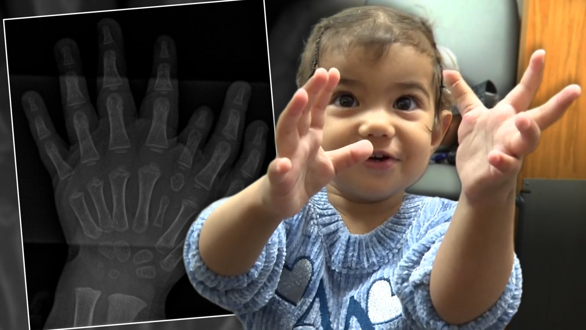 Family Travels From Turkey to St. Louis for Daughter’s Reconstructive Surgery