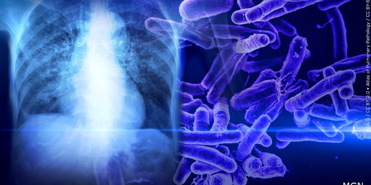 Case of tuberculosis confirmed at middle school in Portland