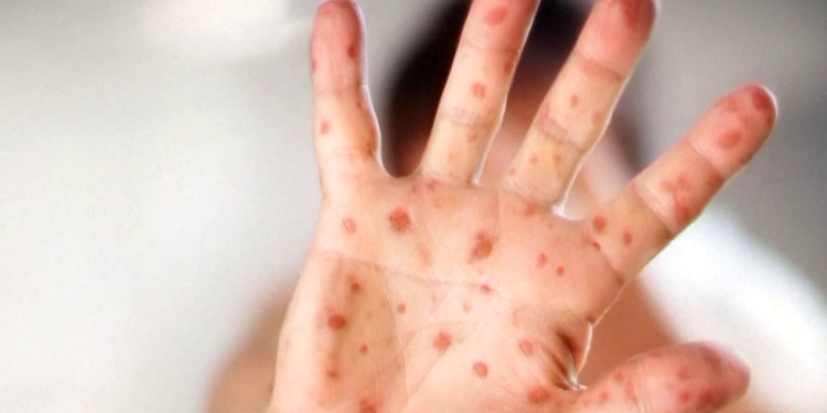 Clark County Public Health says an adult with a confirmed case of measles was at a local high school while they were contagious.